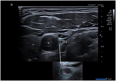 Enlarged cross-sectional area of the left vagus nerve in patients with major depressive disorder